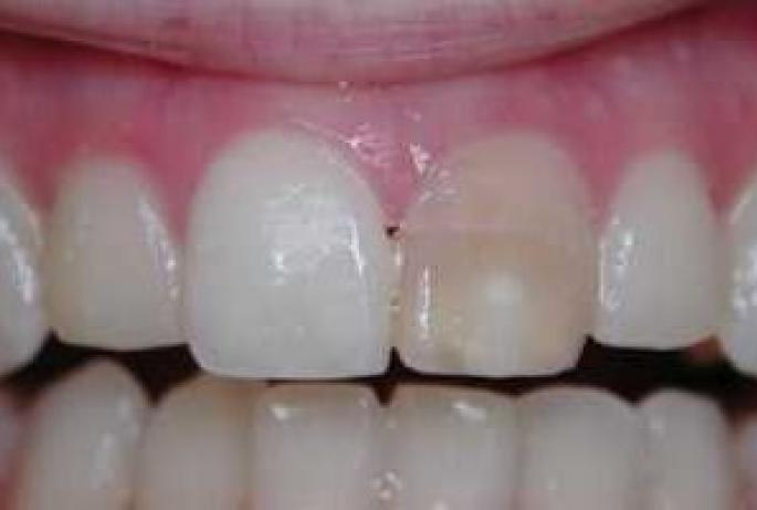 Причины почернения зуба под пломбой