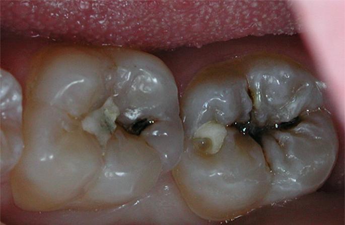 После пломбирования каналов болит зуб при надавливании
