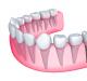 Брекеты и имплантация зубов