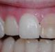 Причины почернения зуба под пломбой