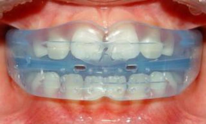 Можно ли выровнять один зуб без брекетов