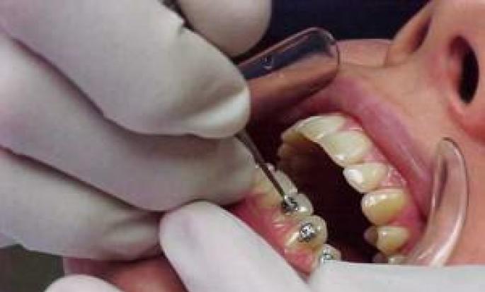 Как ставят брекет-системы на зубы: пошаговое описание с фото и видео Как правильно брекеты